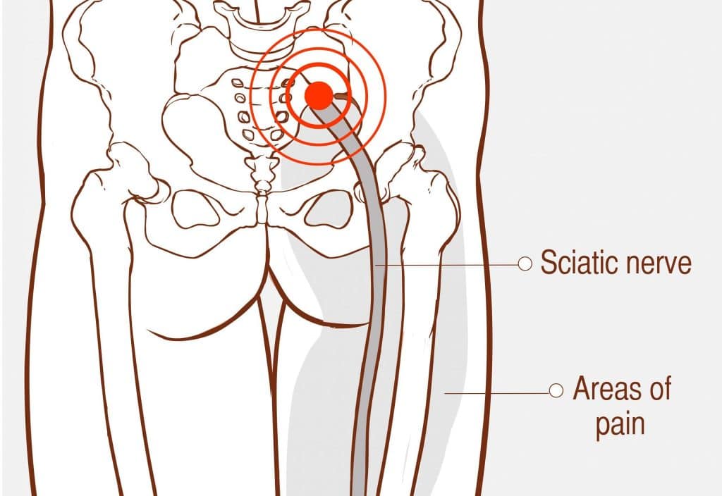 sciatica and orthotics