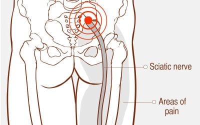 Treating Sciatica With Orthotics