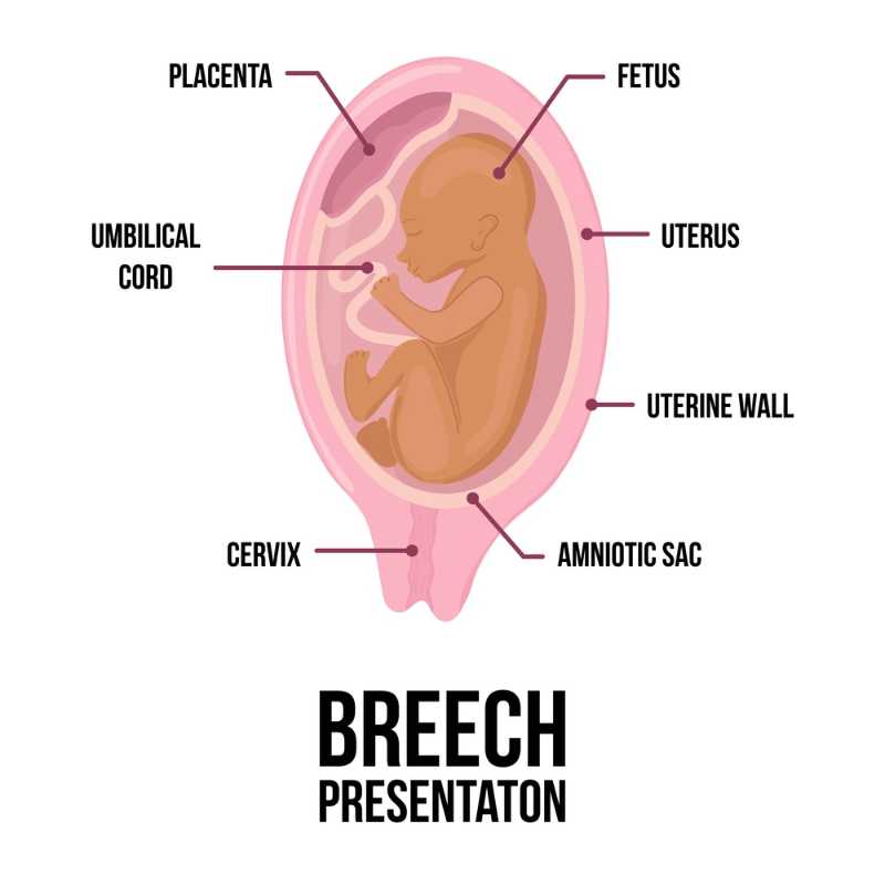 breech baby webster's technique