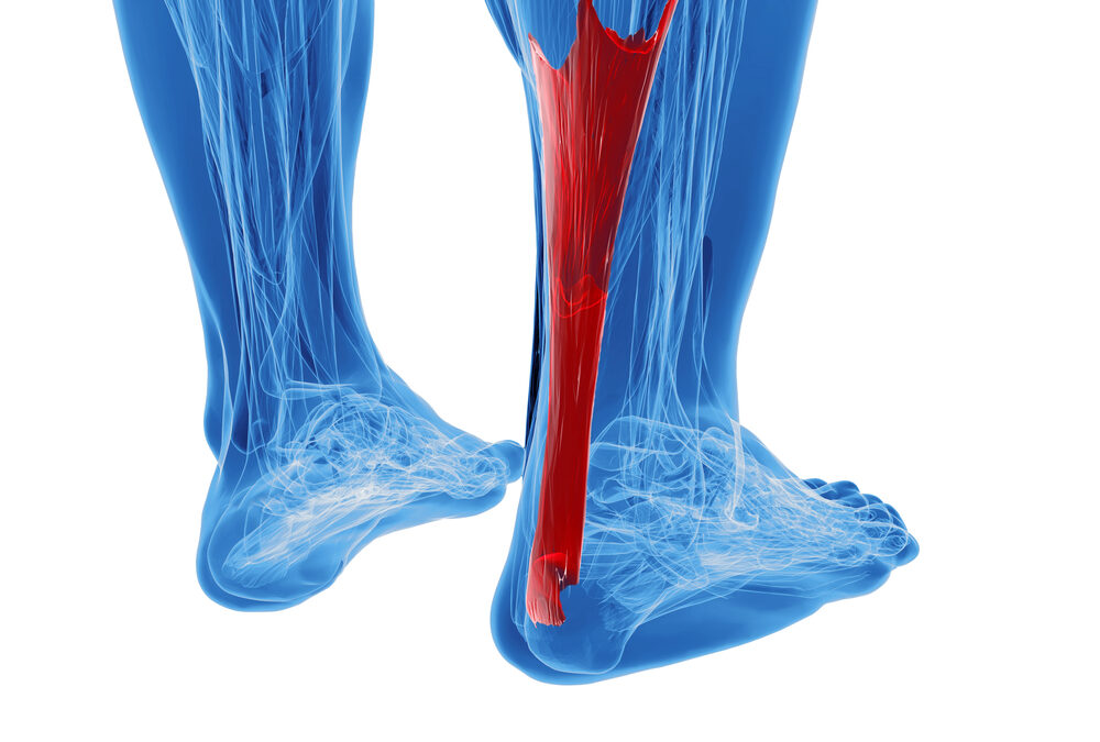 Best Treatment for Achilles Tendonitis?