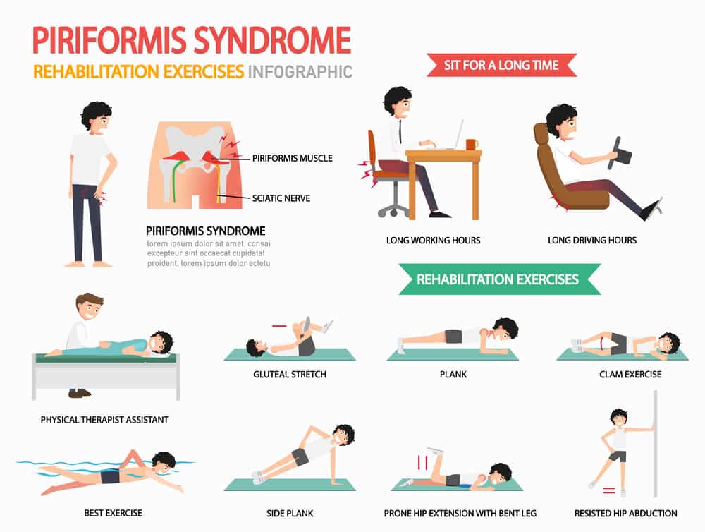 Piriformis Syndrome: Definition - Spine Info