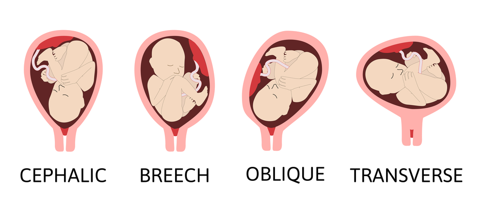 Webster Technique for breech baby position